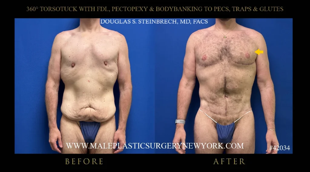 torsotuck-fdl-pectopexy-bodybanking-before-after-ny