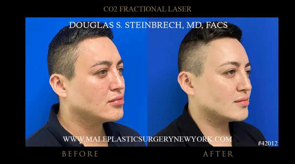 Fractional Laser Resurfacing - Before & After