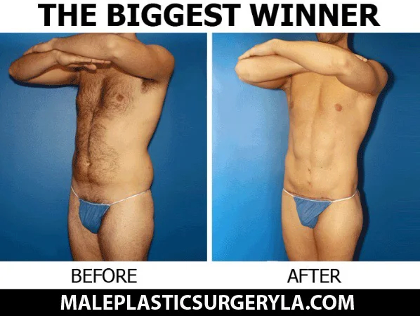 Biggest Winner before and after weight loss stomach and ab contouring 