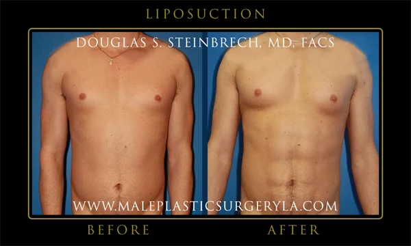 Before and after front view of patient #3 male plastic surgery 