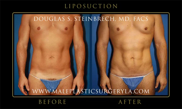 Before and after tummy tuck and contouring 