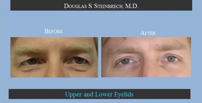 Male Eyelid - Before & After