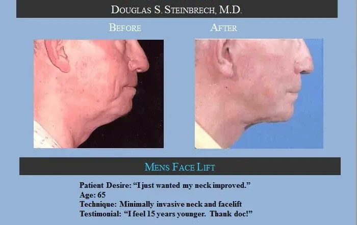 chin surgery facelift in NYC