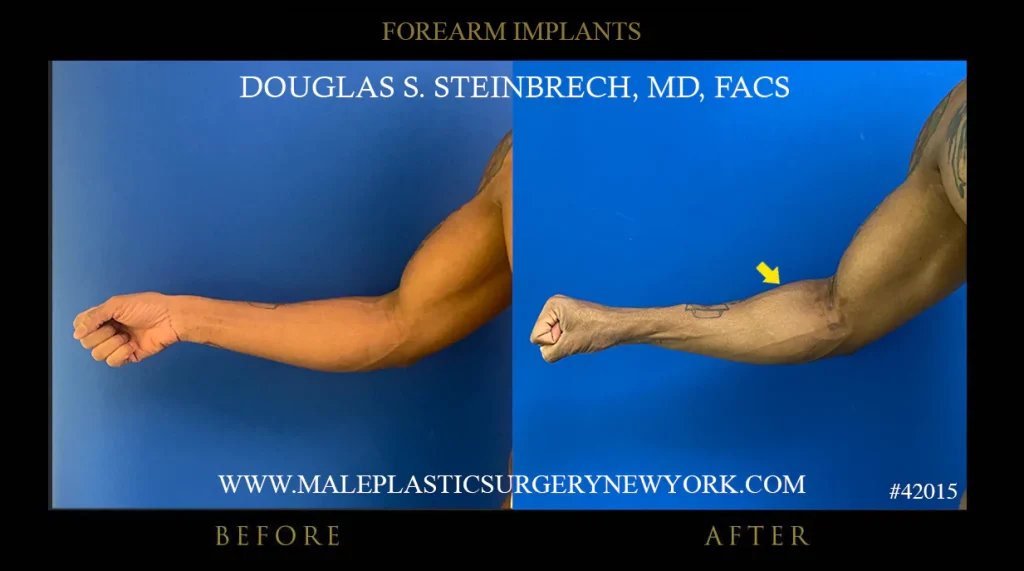 Forearm implant before and after photo 