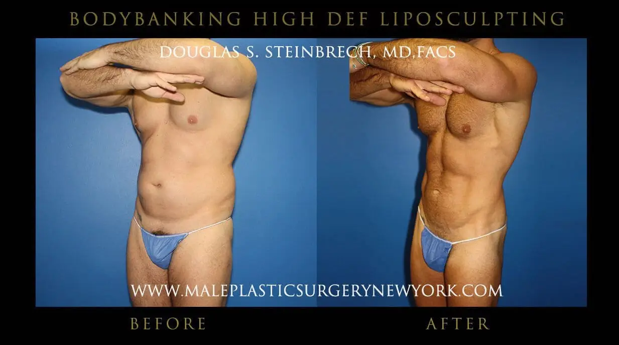 Before and after images of male body transformation showcasing hi-def liposculpting results by Dr. Douglas S. Steinbrech, highlighting enhanced muscle definition and contouring.
