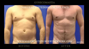 Gynecomastia (Male Chest Reduction)