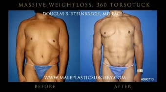 Post-Weight Loss Body Contouring
