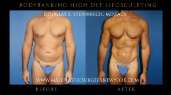 Male Liposuction & Body Sculpting