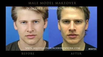 Chin & Jawline Enhancement