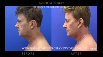 Male Facelift & Facial Rejuvenation